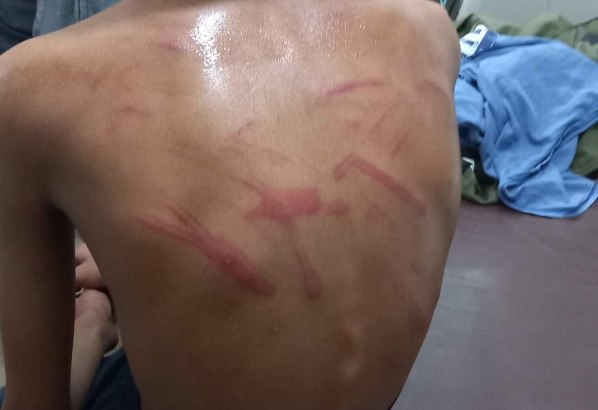 গোলাপগঞ্জে মাদ্রাসা শিক্ষকের বেত্রাঘাতে মারাত্মক আহত ছাত্র